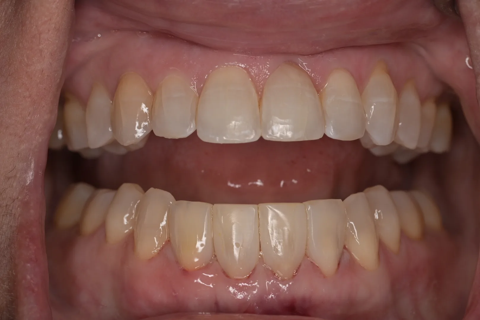 After black triangle closure showing improved lower front tooth contours, actual MDRN Dental Studio patient