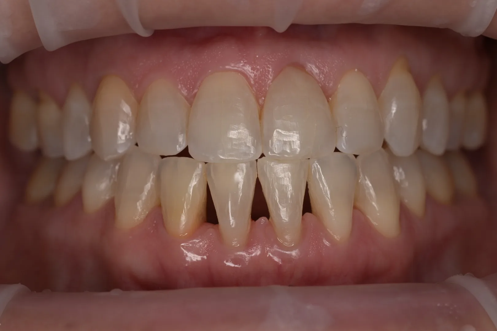 Before black triangle closure showing dark spaces between lower front teeth, actual MDRN Dental Studio patient