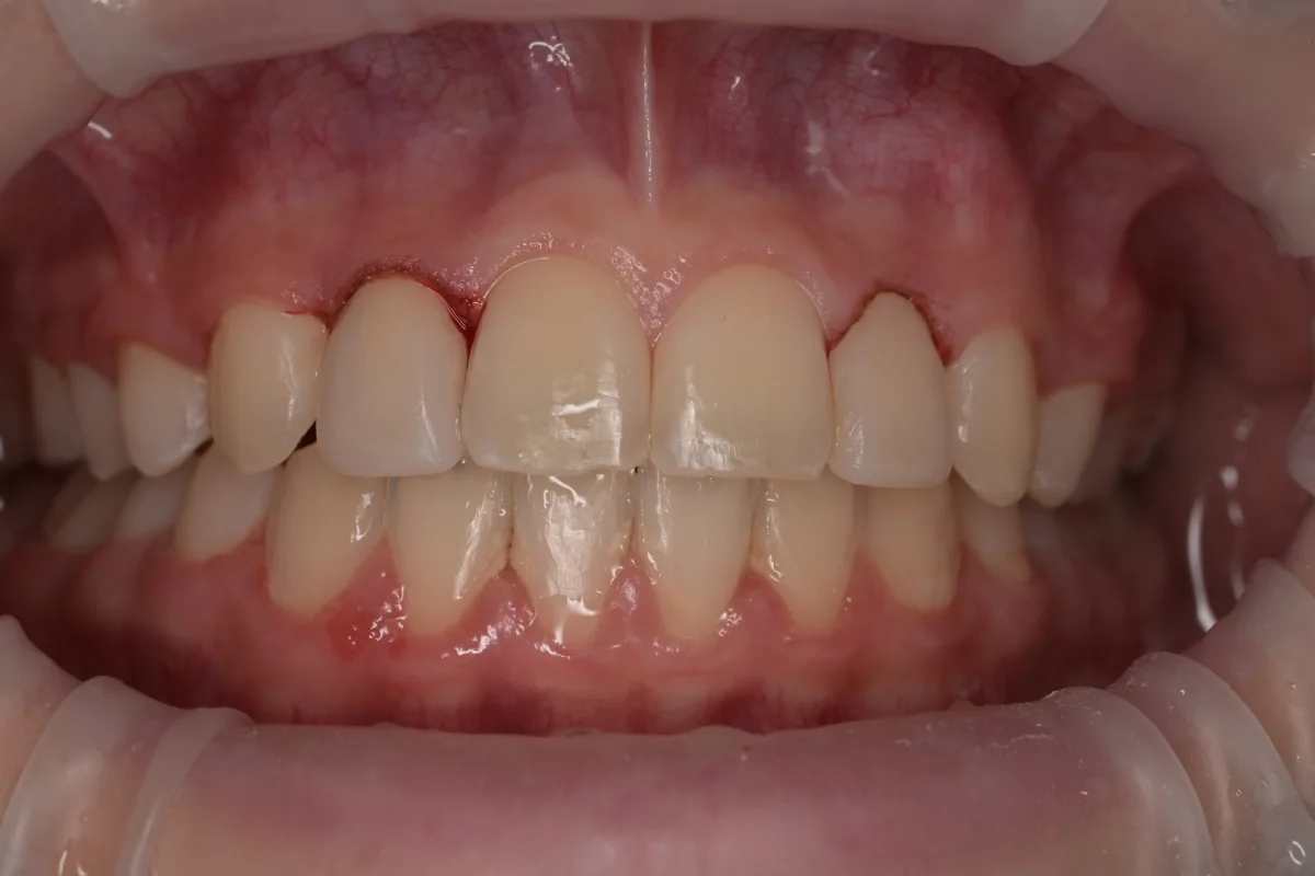 After composite bonding for peg lateral teeth at MDRN Dental Studio
