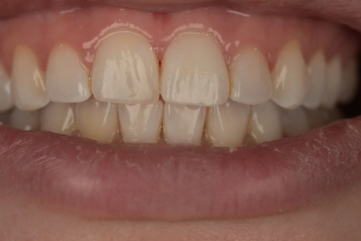 After composite bonding repair for a small incisal chip on tooth number 8