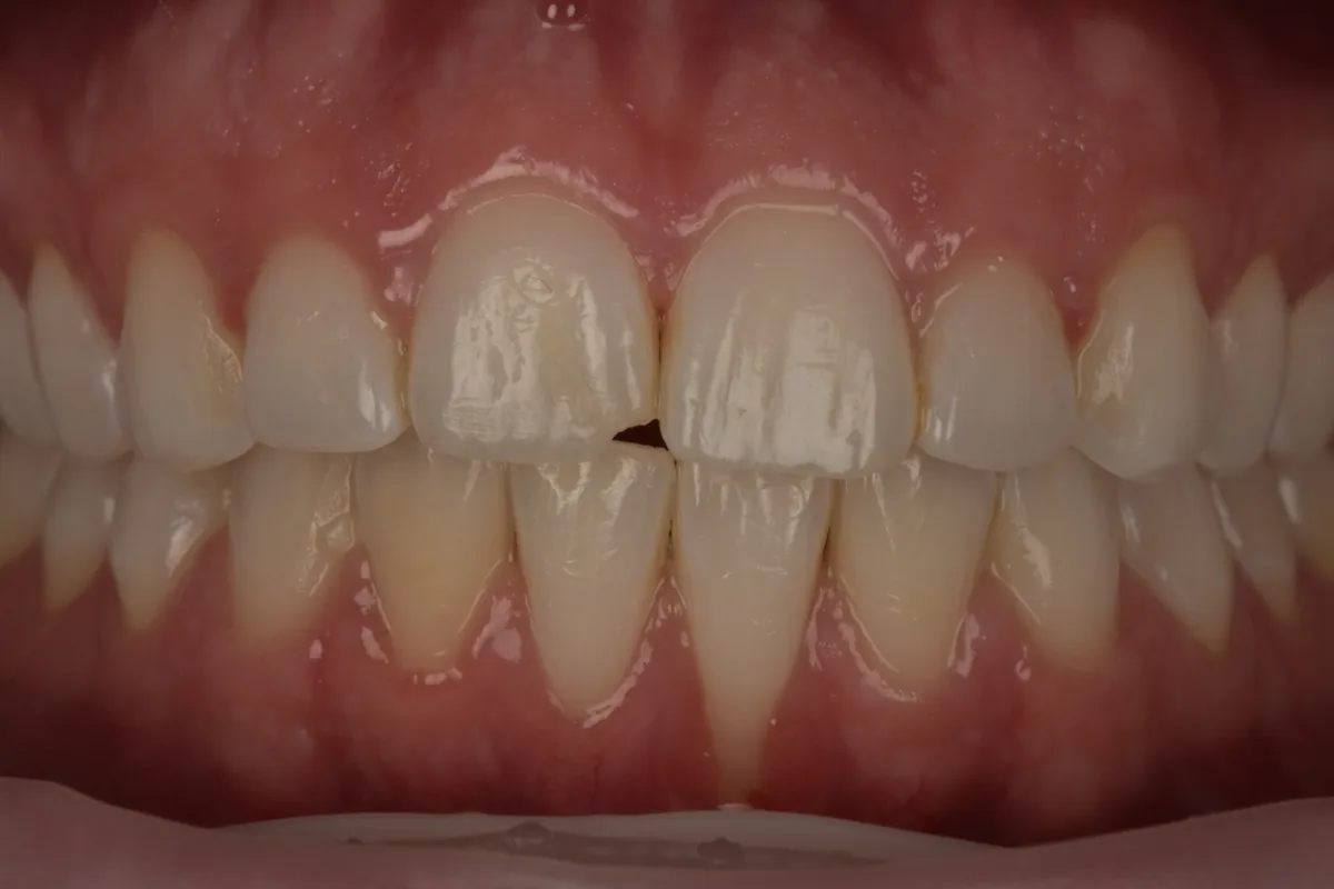 Before composite bonding repair for a small incisal chip on tooth number 8