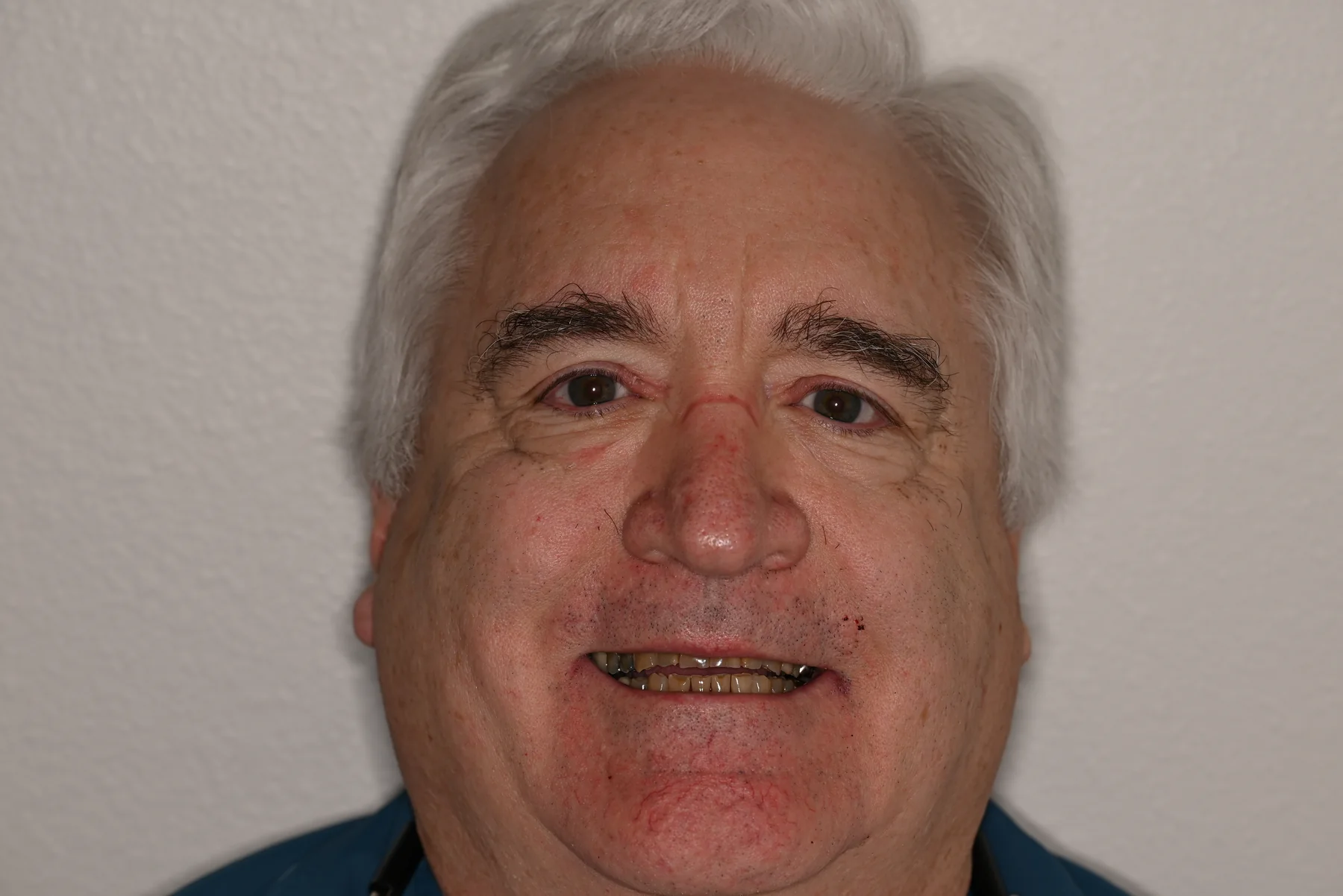 Before full mouth rehabilitation planning, actual MDRN Dental Studio patient smile photo