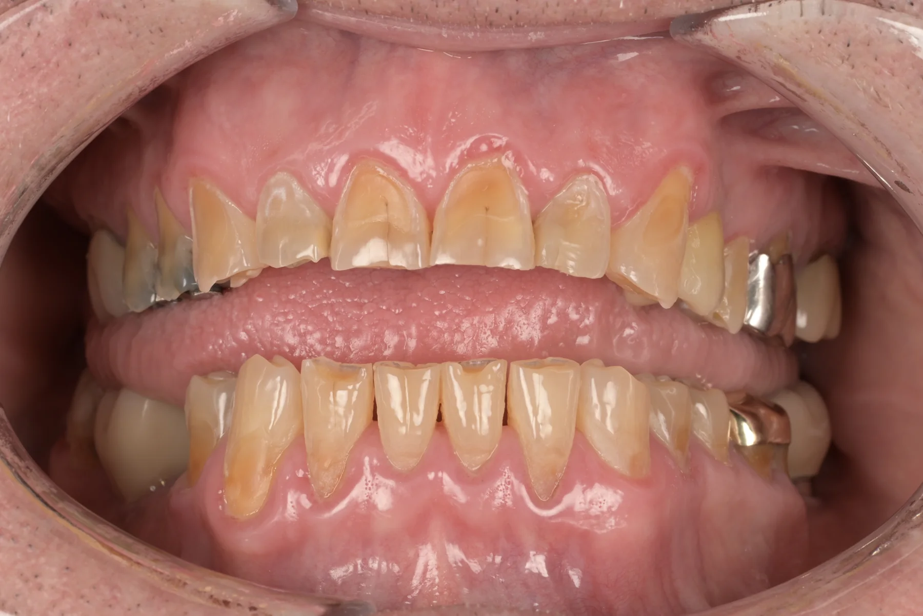 Before comprehensive restorative dental treatment planning, actual MDRN Dental Studio patient close-up dental photo